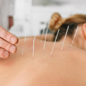 Akupunktur